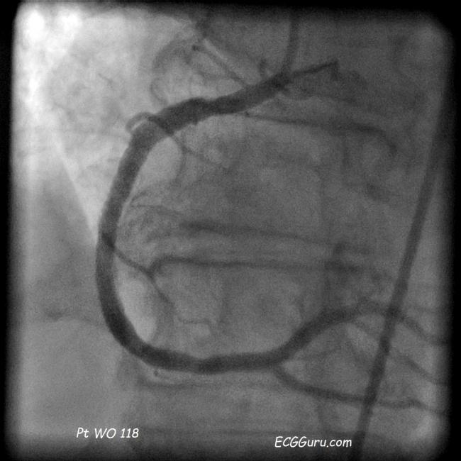 Angioplasty ECG Guru Instructor Resources